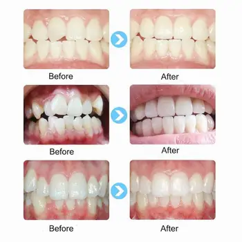 Прозрачни Ортодонтски Тиранти Зъбни Скоби, вградени в Силиконовата Усмивка, Симулатор за изравняване на Зъбите, Хонорар на Зъбите, Защитни скоби